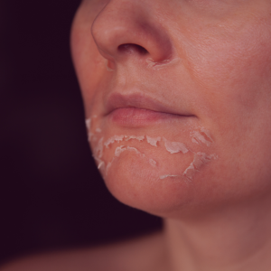 peeling skin on neck