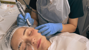 What is Plasma Pen Fibroblast? The long lasting alternative to Botox