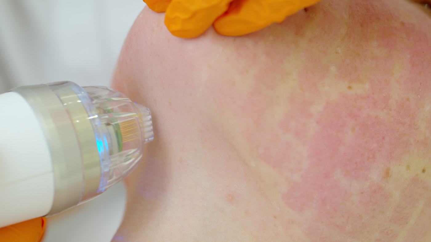 Microneedling training