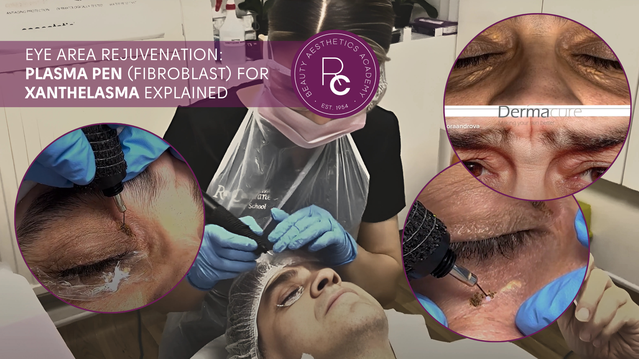 Eye Area Rejuvenation: Plasma Pen (Fibroblast) for Xanthelasma Explained