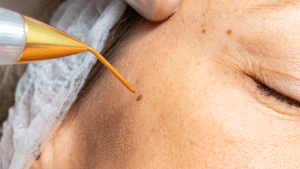 How to Treat Moles Safely: Plasma Pen Mole Removal Explained