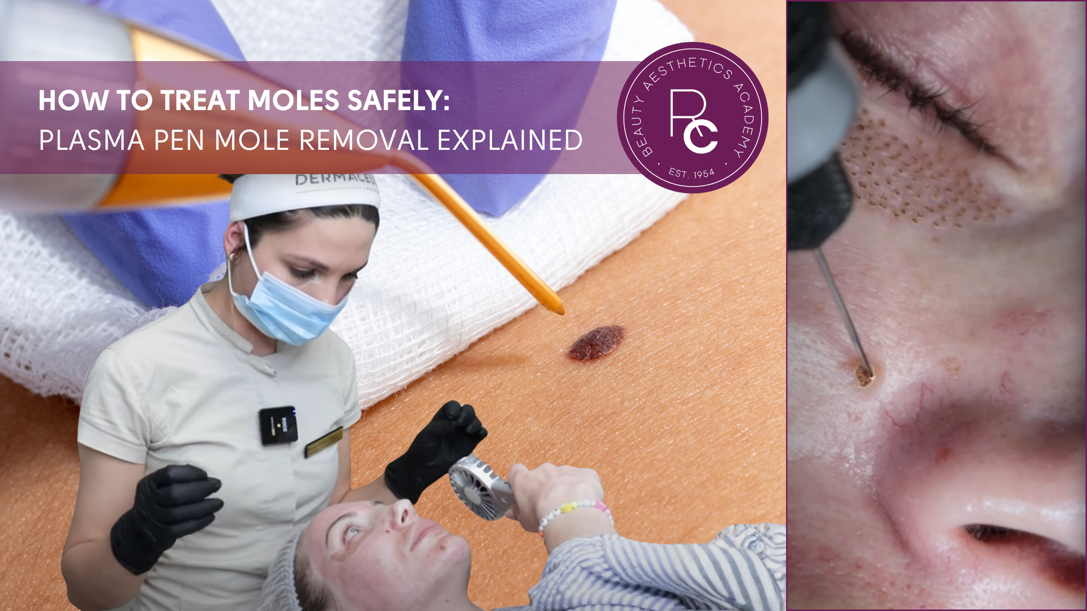 How to Treat Moles Safely: Plasma Pen Mole Removal Explained